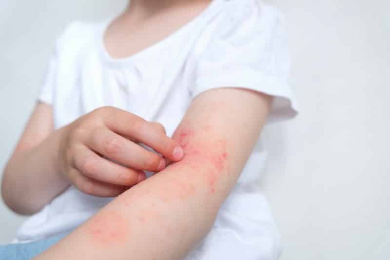 Atopowe zapalenie skóry u dziecka - jak łagodzić objawy?